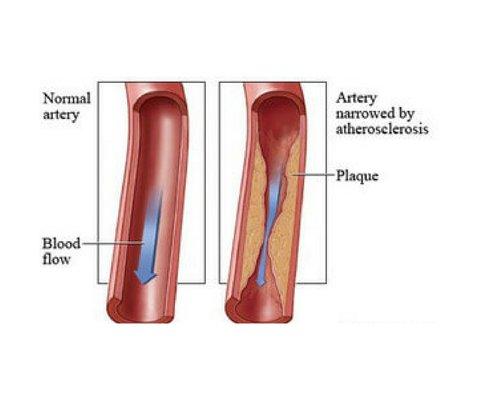 Stent Angio