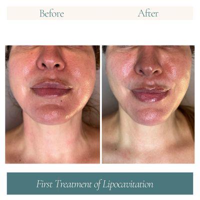 Before & After Face & Neck Tightening