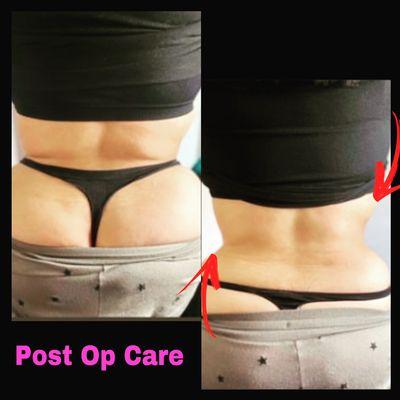 Post op care after lipo