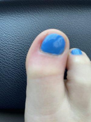 Infected toe