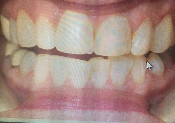 Before upper veneers