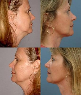 Learn more about neck liposuction http://www.drruas.com/face_procedures.html