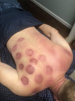 Cupping sessions are available to book!