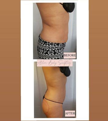 After 6 Sessions of treatments look at the big difference.
Amazing results!