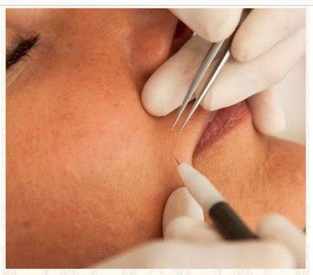 Electrolysis facial hair removal