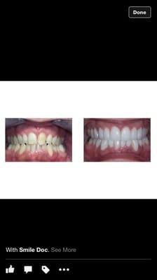 New patient's smile after Invisalign line and Durathin veneers