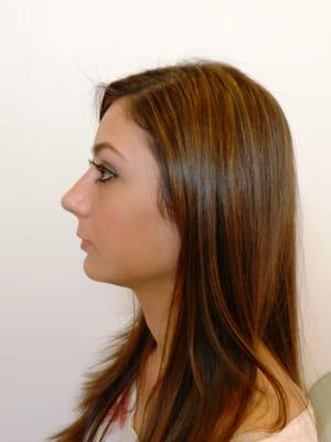 Rhinoplasty/Chin Implant (After, Left Side)