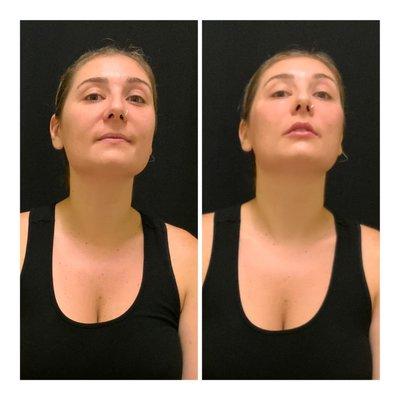 Lip + Cheek Augmentation