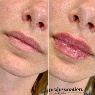 Before and After Lip Filler with Restylane Kysse