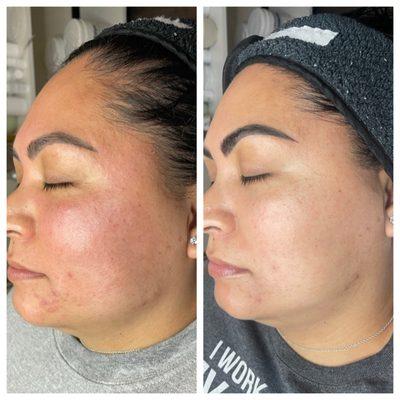 Acne / rosacea facial