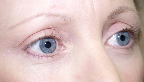 45 year old after blepharoplasty or eyelid surgery. Dr. Rosenthal