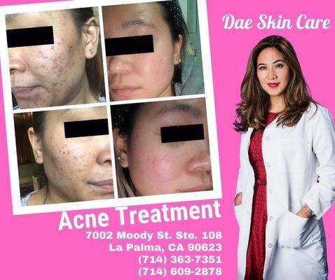 Acne Facial Treatment