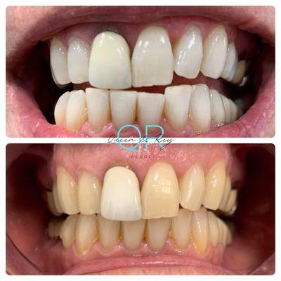 Color matching for those with false teeth. We can whiten your teeth to to match the color of false teeth giving you an even white smile.