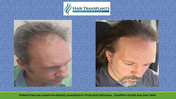 Patient had incredible results with one HTOF Graft Packing hair transplants surgery!