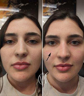 Under Eye Filler Before and After