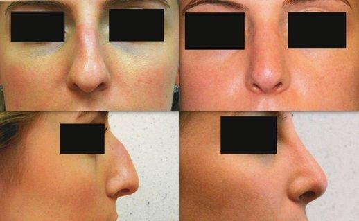 Rhinoplasty