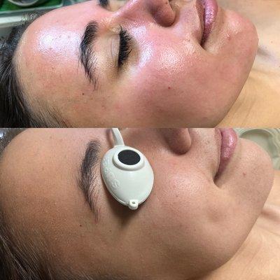 Hydra Dermabrasion Facial!