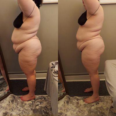 Non-Surgical Lipo - Fat Blast Treatment