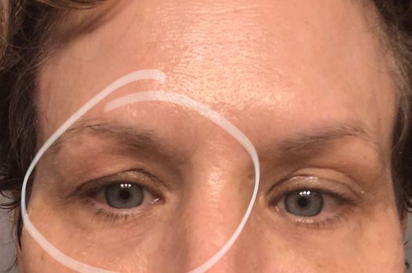 $450 of Botox used on forehead and between eyebrows, when brow lift was specifically asked for to lift eye lids.