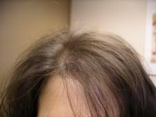 Hair Loss Control Clinic