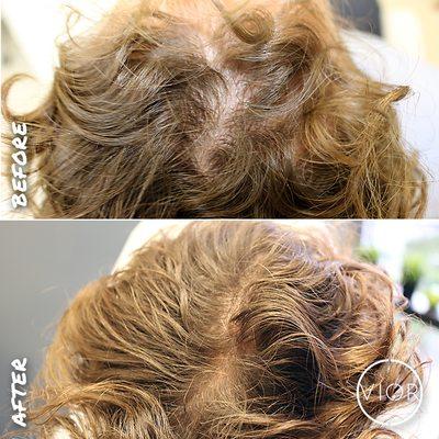 PRP Hair Restoration