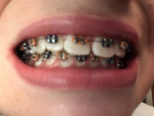 My braces