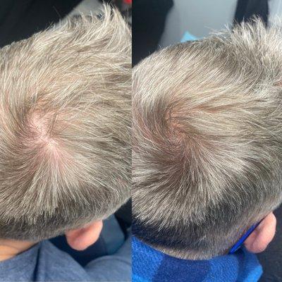 Scalp density with MedInk by Morgan