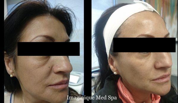 Pre & Post Skin Tightening