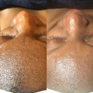 Deep cleansing and Dermaplaning