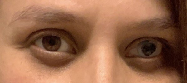 Right eye, after PTK surgery and corneal tattoo.