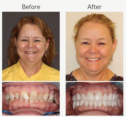 Dr. Reeves completed a full mouth reconstruction using porcelain. This restored her bite to a healthy position.