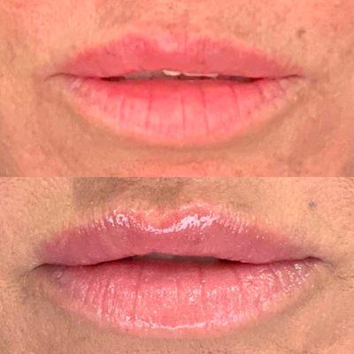 Lip augmentation with Juvederm Ultra XC. Before above and after is below.