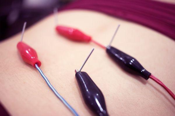 Functional Dry Needling