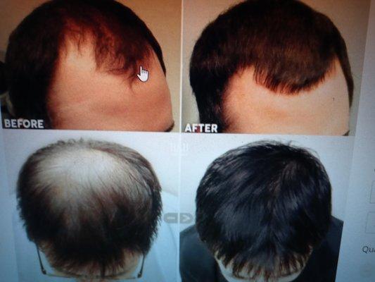 PRP hair restoration