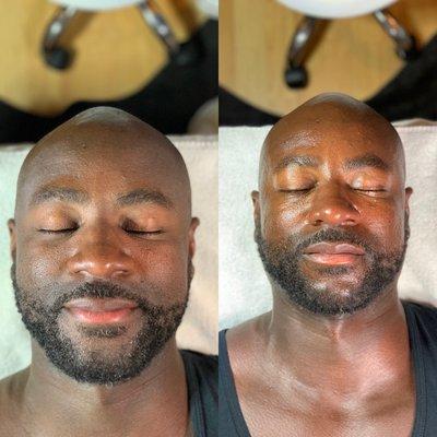 Signature Hydrofacial (before/after)