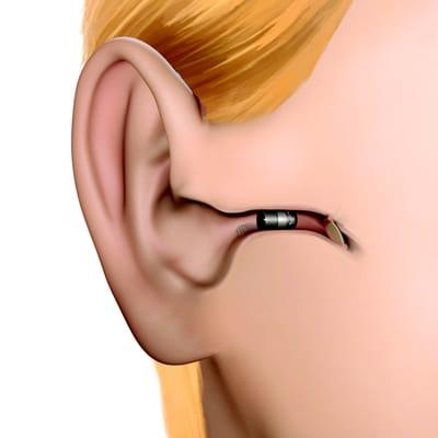 Invisible in the canal (IIC) Hearing Aids. the first custom fit invisible-in-the-canal hearing aid, completely invisible