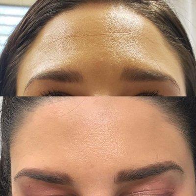 Before and after Botox to the forehead!