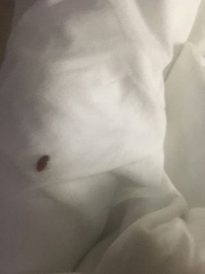 Bedbugs in hospital bed