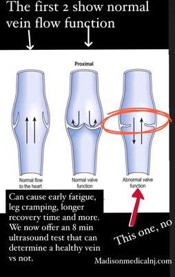 Vein screening