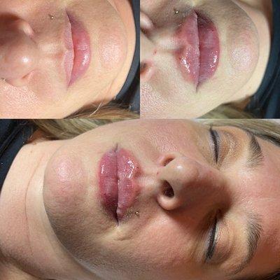 Needle-less lip plumping!!! No down time, pain free, all natural hyaluronic acid filler.