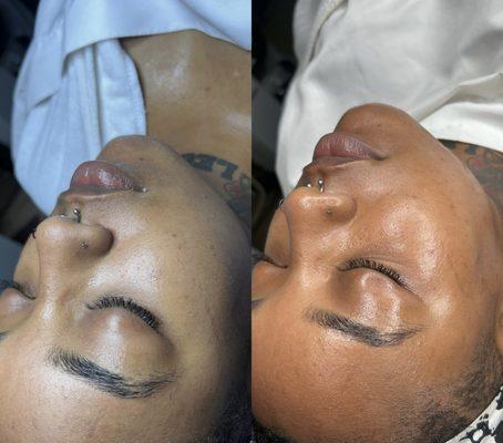 Before and after a dermaplaning facial!