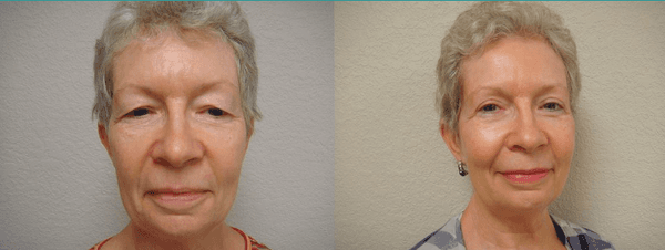 Before & After Results at The Center for Cosmetic Medicine | Monticello, IL