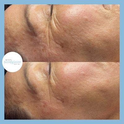 Hollywood Facial with Dermaplane and Nano Infusion