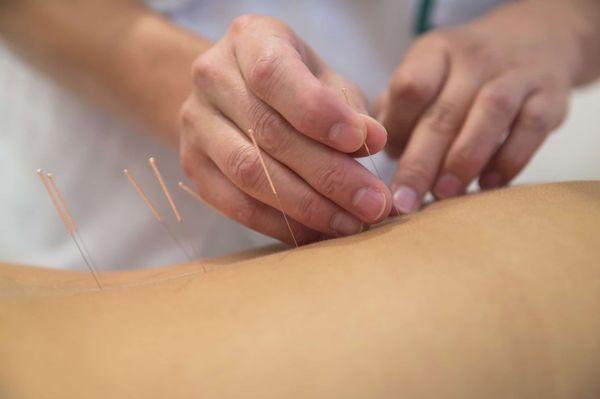 Acupuncture for back pain