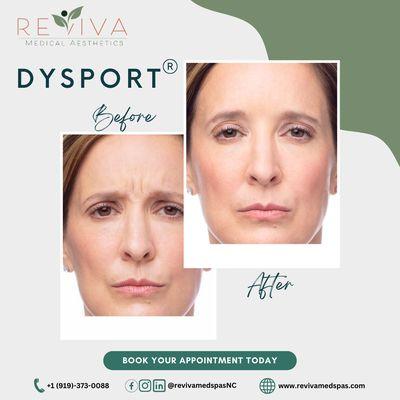 The future of beauty is here. Dysport Injection Wow! See the dramatic results of Dysport! Just a few weeks after treatment .