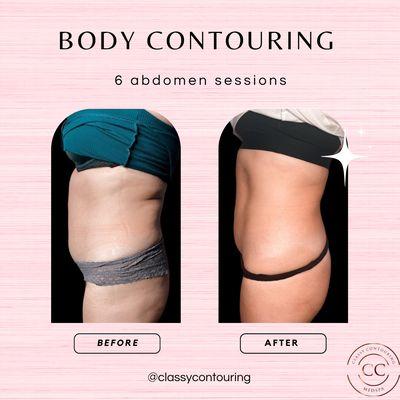 Body contouring mesa