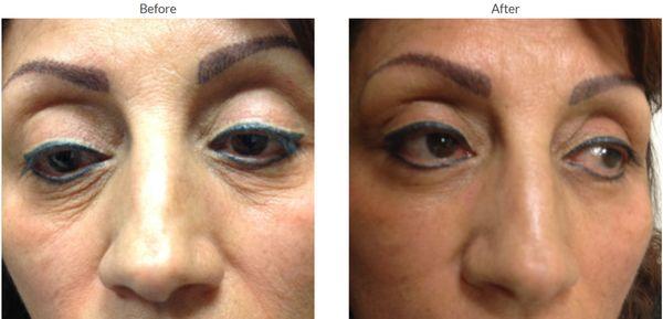 Blepharoplasty Eyelid Surgery