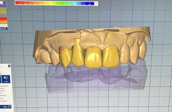 In house lab design and mill to deliver same day all ceramic crowns and bridges