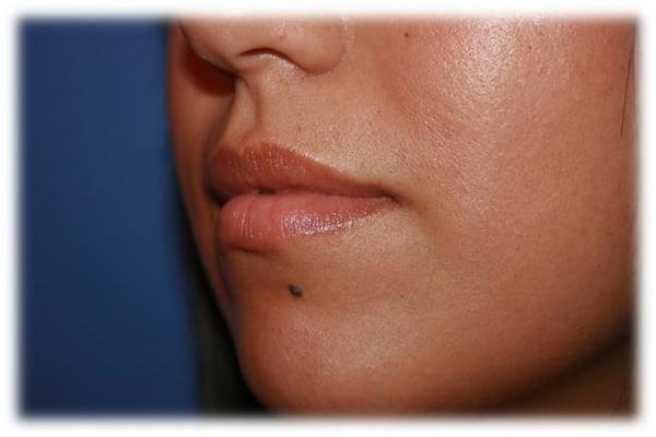 Dermal Filler for lips- Pre Procedure