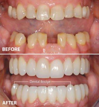 Before and After at NÜVA Smile | Bergenfield, NJ